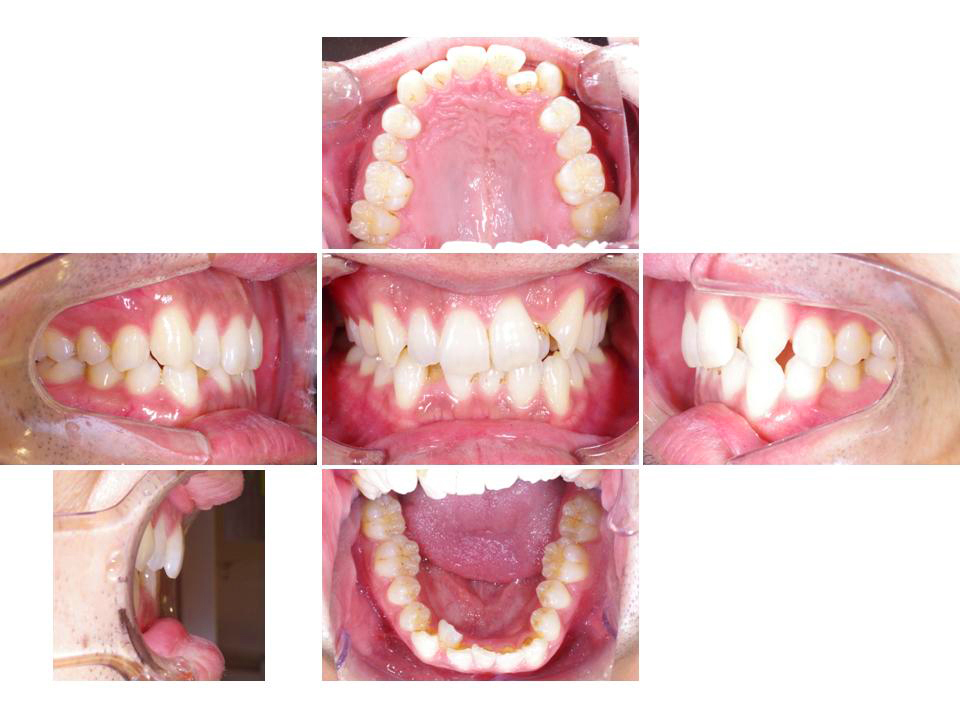 3年保証』 歯科矯正 顎間ゴム ゴムかけ 歯並び ワイヤー インビザライン マウスピース矯正